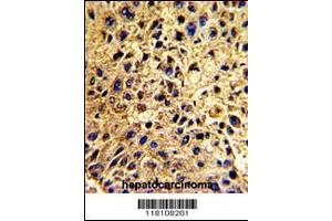 Formalin-fixed and paraffin-embedded human hepatocarcinoma with , which was peroxidase-conjugated to the secondary antibody, followed by DAB staining. (NUP62 抗体  (C-Term))