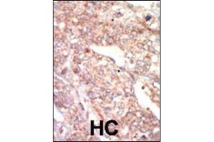 Formalin-fixed and paraffin-embedded human cancer tissue reacted with the primary antibody, which was peroxidase-conjugated to the secondary antibody, followed by AEC staining. (EPHA1 抗体  (N-Term))