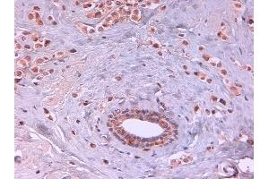 Immunohistochemistry of Rat monoclonal anti AKT2 unconjugated Antibody in human breast carcinoma. (AKT2 抗体  (Internal Region) (FITC))