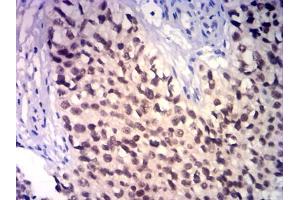 Immunohistochemical analysis of paraffin-embedded bladder cancer tissues using GATA3 mouse mAb with DAB staining. (GATA3 抗体)