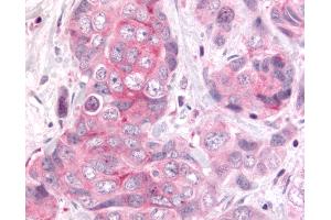 Anti-DUSP22 / JSP 1 antibody IHC of human Colon, Carcinoma. (DUSP22 抗体  (Internal Region))