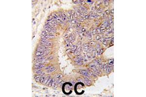 Formalin-fixed and paraffin-embedded human colon carcinoma tissue reacted with PDE8A polyclonal antibody  , which was peroxidase-conjugated to the secondary antibody, followed by DAB staining. (PDE8A 抗体  (Leu572))