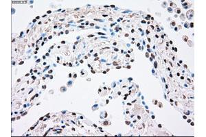 Immunohistochemical staining of paraffin-embedded Adenocarcinoma of breast tissue using anti-PLK1 mouse monoclonal antibody. (PLK1 抗体)