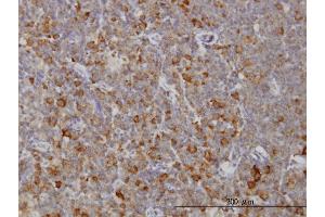 Immunoperoxidase of monoclonal antibody to RAB8A on formalin-fixed paraffin-embedded human lymphoma. (RAB8A 抗体  (AA 108-207))