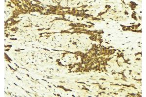 ABIN6269179 at 1/100 staining Human breast cancer tissue by IHC-P. (AFT1 抗体  (Internal Region))