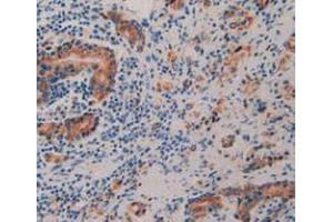 IHC-P analysis of Human Prostate Gland Cancer Tissue, with DAB staining. (Prolactin Receptor 抗体  (AA 25-234))