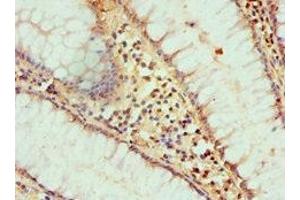 Immunohistochemistry of paraffin-embedded human colon cancer using ABIN7155290 at dilution of 1:100 (HAT1 抗体  (Catalytic Subunit))