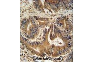 VPS52 antibody (C-term) (ABIN654879 and ABIN2844533) immunohistochemistry analysis in formalin fixed and paraffin embedded human colon carcinoma followed by peroxidase conjugation of the secondary antibody and DAB staining.