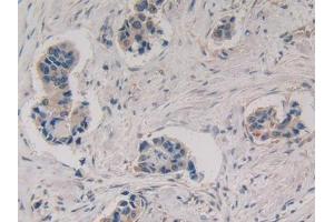 DAB staining on IHC-P; Samples: Human Breast cancer Tissue (MMP3 抗体  (AA 363-477))