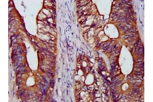 IHC image of ABIN7145178 diluted at 1:1200 and staining in paraffin-embedded human colon cancer performed on a Leica BondTM system. (BCAP31 抗体  (AA 2-243))