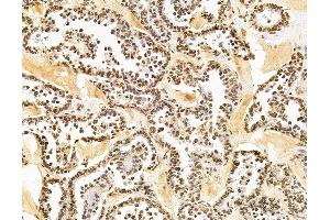 ABIN7095883 and ABIN7099945 at 1/100 staining human ovarian cancer by IHC-P. (PHRF1 抗体)