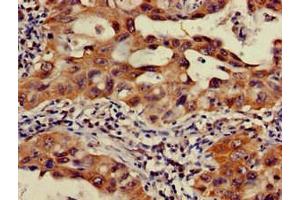 Immunohistochemistry of paraffin-embedded human lung cancer using ABIN7165899 at dilution of 1:100 (OS9 抗体  (AA 232-413))