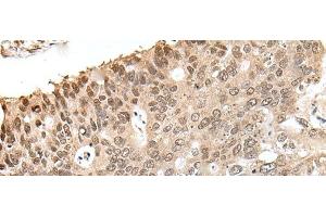 Immunohistochemistry of paraffin-embedded Human colorectal cancer tissue using ZNF410 Polyclonal Antibody at dilution of 1:40(x200) (ZNF410 抗体)