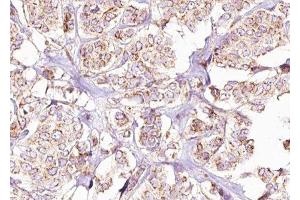 ABIN6275431 at 1/100 staining Human breast cancer tissue by IHC-P. (PDHA1 抗体  (C-Term))