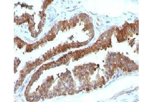 Formalin-fixed, paraffin-embedded human prostate carcinoma stained with HSP27 antibody (HSPB1/774) (HSP27 抗体)