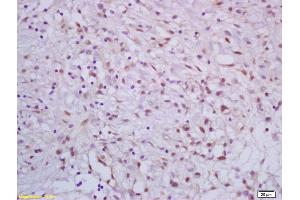 Formalin-fixed and paraffin embedded human gastric carcinoma labeled with Rabbit Anti APC70/CRSP70 Polyclonal Antibody, Unconjugated (ABIN1387561) at 1:200 followed by conjugation to the secondary antibody and DAB staining