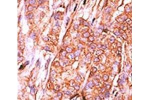 IHC analysis of FFPE human breast carcinoma tissue stained with the CTDSP2 antibody (CTDSP2 抗体  (AA 12-42))
