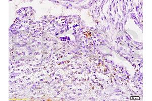 Formalin-fixed and paraffin embedded human breast carcinoma tissue labeled with Anti-Cathepsin H Polyclonal Antibody, Unconjugated (ABIN732758) at 1:200 followed by conjugation to the secondary antibody, (SP-0023), and DAB staining (Cathepsin H 抗体  (AA 71-170))
