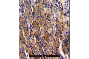SYNE3 antibody immunohistochemistry analysis in formalin fixed and paraffin embedded human hodgkin lymphoma followed by peroxidase conjugation of the secondary antibody and DAB staining. (Nesprin3 抗体  (C-Term))
