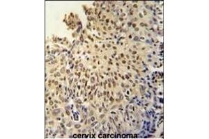 DI3L1 Antibody (N-term) (ABIN651802 and ABIN2840405) immunohistochemistry analysis in formalin fixed and paraffin embedded human cervix carcinoma followed by peroxidase conjugation of the secondary antibody and DAB staining. (DIS3L 抗体  (N-Term))