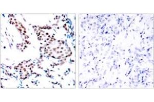 Immunohistochemistry analysis of paraffin-embedded human breast carcinoma tissue, using c-Jun (Ab-170) Antibody. (C-JUN 抗体  (AA 137-186))