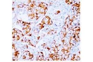 Immunohistochemical analysis of Paraffin Embeedded Mammary cancer sections using FGF2 antibody. (FGF2 抗体  (N-Term))