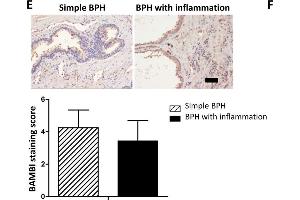 Expression of TLR4, BAMBI, p-Smad2/3 in BPH patient samples.