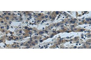 Immunohistochemistry of paraffin-embedded Human liver cancer tissue using CUL5 Polyclonal Antibody at dilution of 1:55(x200) (Cullin 5 抗体)
