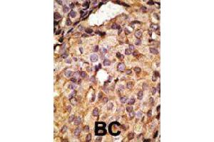 Formalin-fixed and paraffin-embedded human cancer tissue reacted with Tlr6 polyclonal antibody  , which was peroxidase-conjugated to the secondary antibody, followed by AEC staining. (TLR6 抗体  (C-Term))