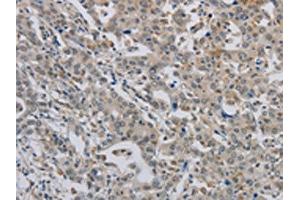 The image on the left is immunohistochemistry of paraffin-embedded Human liver cancer tissue using ABIN7189784(ALX4 Antibody) at dilution 1/20, on the right is treated with synthetic peptide. (ALX4 抗体)