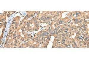 Immunohistochemistry of paraffin-embedded Human thyroid cancer tissue using FAM110B Polyclonal Antibody at dilution of 1:40(x200) (FAM110B 抗体)