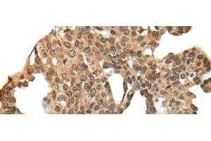 Immunohistochemistry of paraffin-embedded Human thyroid cancer tissue using APC Polyclonal Antibody at dilution of 1:45(x200)