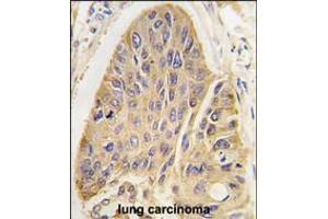 Formalin-fixed and paraffin-embedded human lung carcinoma tissue reacted with hMAP2-Q425 antibody, which was peroxidase-conjugated to the secondary antibody, followed by DAB staining. (MAP2 抗体  (C-Term))