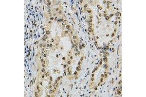 Immunohistochemical analysis of JUNB staining in human lung cancer formalin fixed paraffin embedded tissue section. (JunB 抗体)