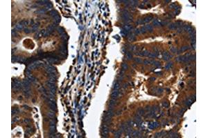 The image on the left is immunohistochemistry of paraffin-embedded Human colon cancer tissue using ABIN7191225(KLHL8 Antibody) at dilution 1/20, on the right is treated with synthetic peptide. (KLHL8 抗体)