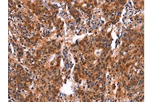 The image on the left is immunohistochemistry of paraffin-embedded Human gastric cancer tissue using ABIN7190641(FEM1A Antibody) at dilution 1/20, on the right is treated with synthetic peptide. (FEM1A 抗体)