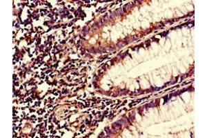 Immunohistochemistry of paraffin-embedded human colon cancer using ABIN7166034 at dilution of 1:100 (S1A1 (AA 2-97) 抗体)