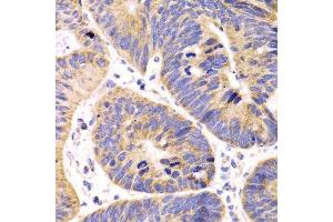 Immunohistochemistry of paraffin-embedded human colon carcinoma using HMGCL antibody.