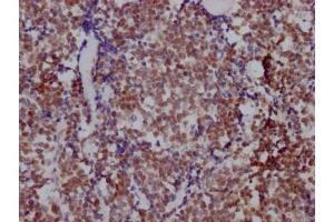IHC image of ABIN7127539 diluted at 1:100 and staining in paraffin-embedded human lung cancer performed on a Leica BondTM system. (Recombinant HDAC3 抗体)