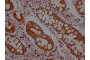 IHC image of ABIN7127629 diluted at 1:100 and staining in paraffin-embedded human colon cancer performed on a Leica BondTM system.
