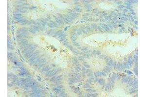 Immunohistochemistry of paraffin-embedded human colon cancer using ABIN7147590 at dilution of 1:100 (CLIC4 抗体  (AA 1-253))