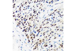 Immunohistochemistry of paraffin-embedded Human esophageal cancer using WDHD1 Rabbit pAb (ABIN7271351) at dilution of 1:100 (40x lens). (WDHD1 抗体  (AA 830-1129))