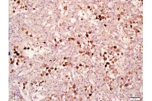 Formalin-fixed and paraffin embedded human lung carcinoma labeled with Anti-Phospho-MAPKAPK2(Thr334) Polyclonal Antibody, Unconjugated (ABIN743693) at 1:200 followed by conjugation to the secondary antibody and DAB staining (MAPKAP Kinase 2 抗体  (pThr334))