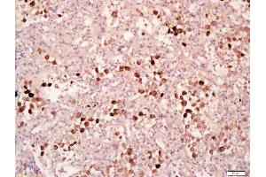 Formalin-fixed and paraffin embedded human lung carcinoma labeled with Anti-Phospho-MAPKAPK2(Thr334) Polyclonal Antibody, Unconjugated (ABIN743693) at 1:200 followed by conjugation to the secondary antibody and DAB staining