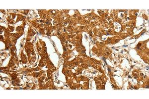Immunohistochemistry of paraffin-embedded Human lung cancer using Otocadherin Polyclonal Antibody at dilution of 1:80 (CDH23 抗体)