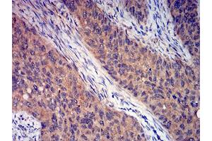 Immunohistochemical analysis of paraffin-embedded cervical cancer tissues using GRM3 mouse mAb with DAB staining. (Metabotropic Glutamate Receptor 3 抗体  (AA 433-576))