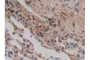 Detection of CYTH1 in Human Lung cancer Tissue using Polyclonal Antibody to Cytohesin 1 (CYTH1)