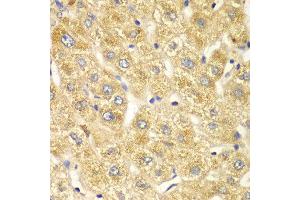 Immunohistochemistry of paraffin-embedded human liver injury using OGT antibody at dilution of 1:100 (x40 lens). (OGT 抗体)
