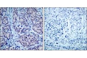 Immunohistochemistry analysis of paraffin-embedded human breast carcinoma tissue, using HDAC2 (Ab-394) Antibody. (HDAC2 抗体  (AA 360-409))