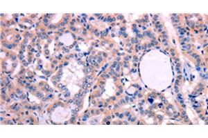 Immunohistochemistry of paraffin-embedded Human thyroid cancer tissue using LEP Polyclonal Antibody at dilution 1:30 (Leptin 抗体)